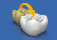 CEREC AC OMNICAM ПРОСТОЕ СКАНИРОВАНИЕ БЕЗ АНТИБЛИКОВОГО СПРЕЯ 17.jpg CEREC AC OMNICAM ПРОСТОЕ СКАНИРОВАНИЕ БЕЗ АНТИБЛИКОВОГО СПРЕЯ 17.jpg